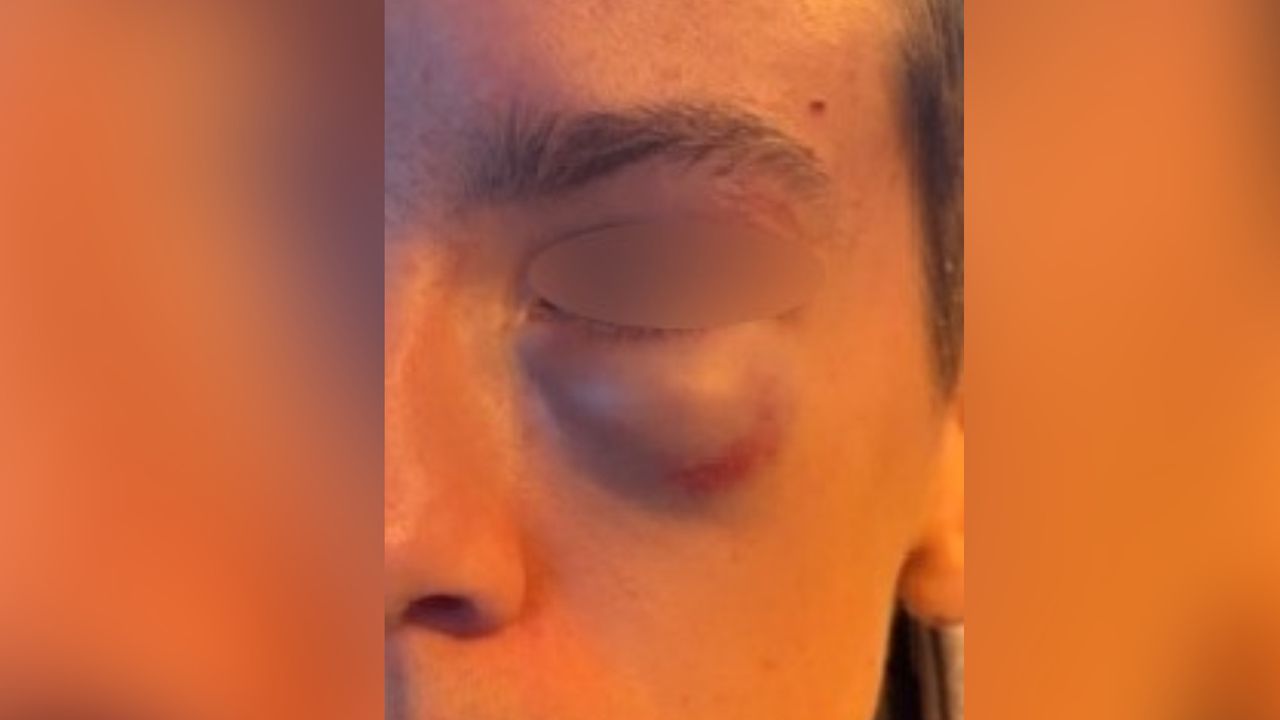Een van de slachtoffers hield een flink blauw oog op bij de mishandeling (foto: politie).
