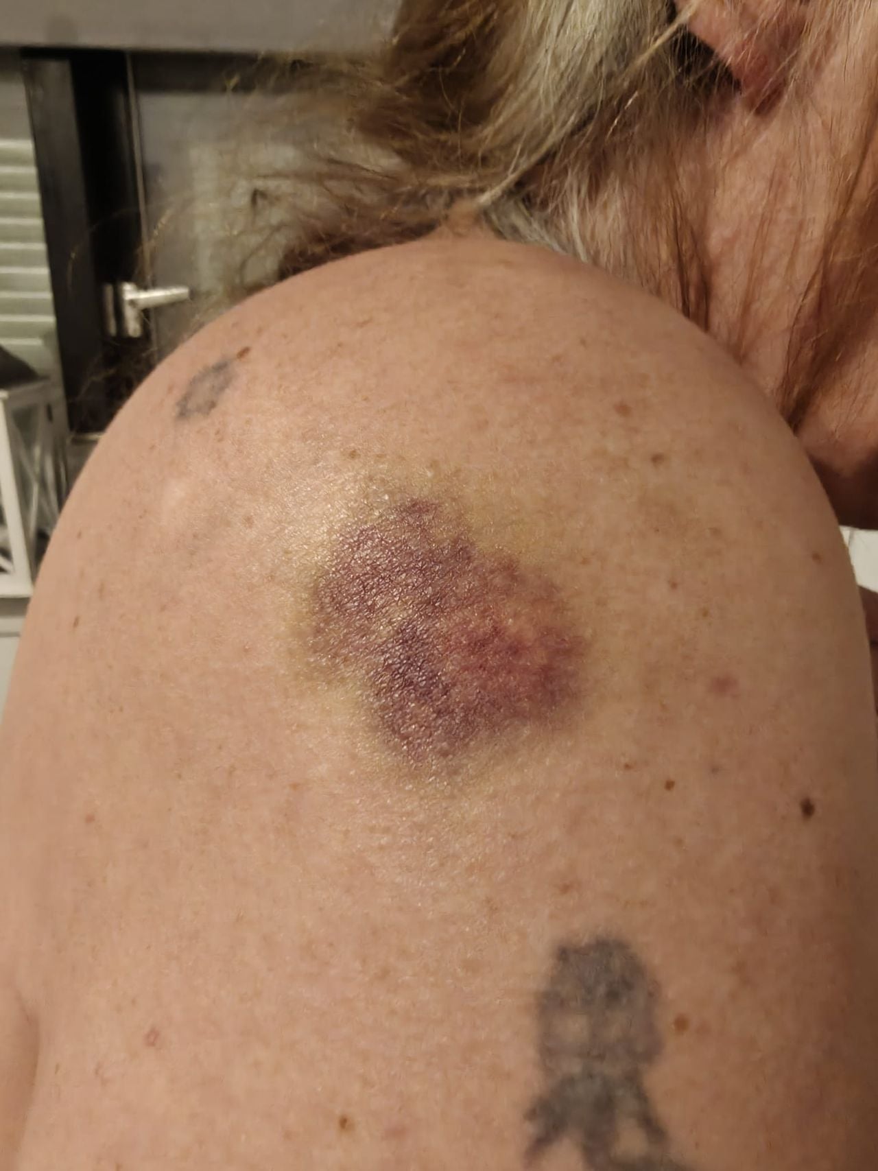 Sandra haar hoofd tot schouder zit onder de bloeduitstortingen (foto: Sandra van Elewout). 