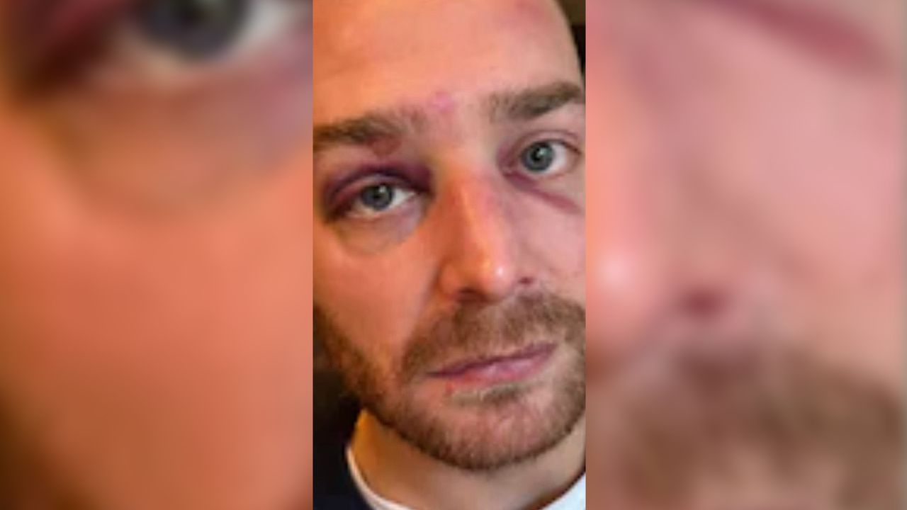 Het gehavende gezicht van Vic Jacobs na de overval (foto: Bart Jacobs).