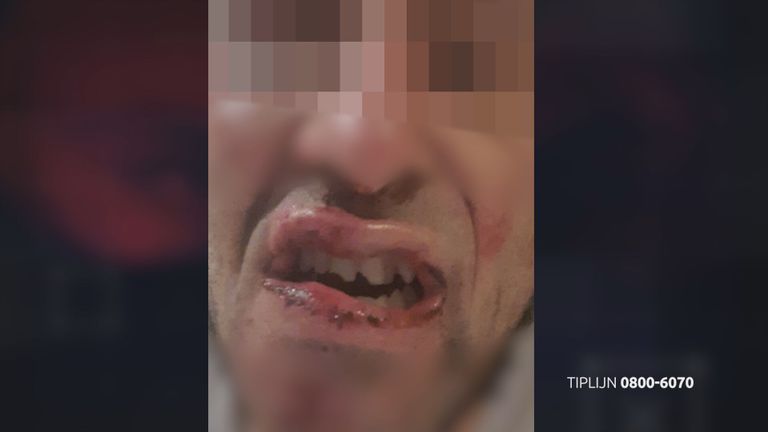De verwondingen in het gezicht van het slachtoffer (Foto: Bureau Brabant)