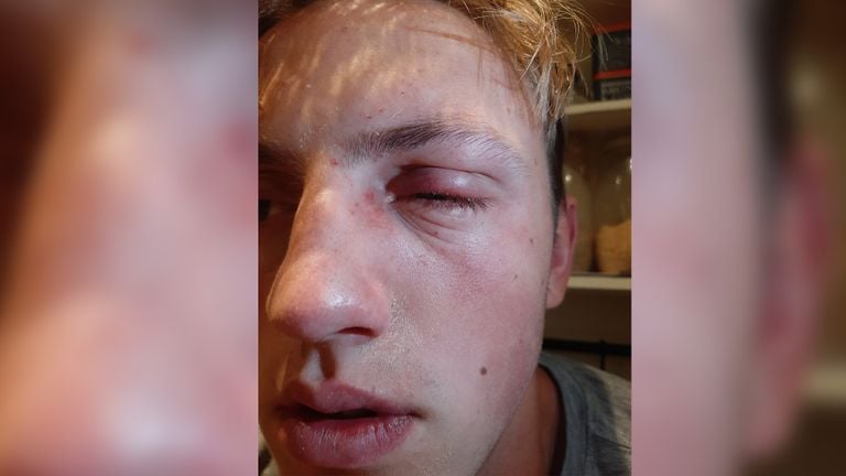 De zwelling nam snel toe (foto:privécollectie)