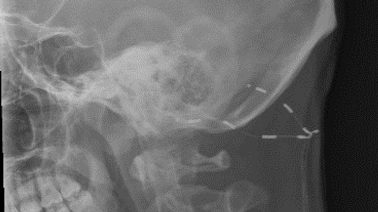 een röntgenfoto van het implantaat 