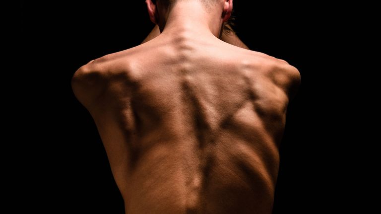 Toen Max groeide werd zijn rug steeds krommer. (Foto: Arjan Spannenburg)