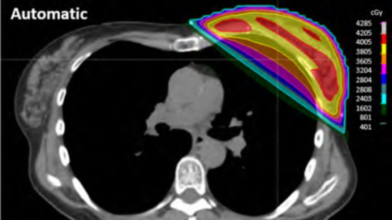 La differenza di colore indica il livello di dose del cancro al seno (Immagine: Ospedale Katarina). 